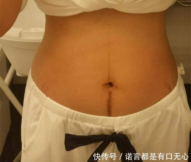 秘密|怀孕后肚子上的“黑线”是什么?妊娠中线的秘密,你有必要了解