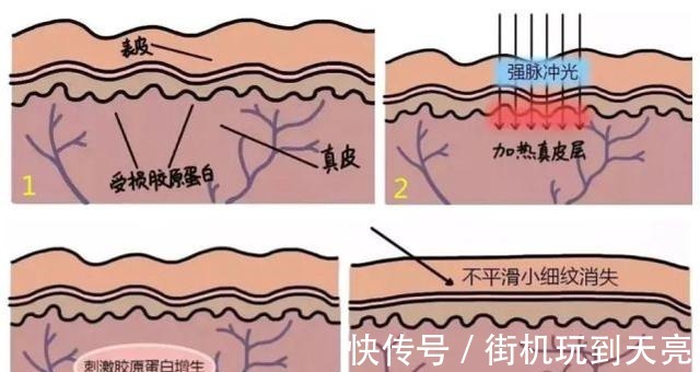 真皮层 想要嫩肤，究竟选择水光针还是光子嫩肤！