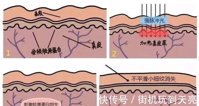 真皮层 想要嫩肤,究竟选择水光针还是光子嫩肤!