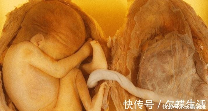 多胞胎|孕妇怀孕3个月，肚子大到行动不便，孕检后一家人很纠结