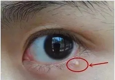 质地的眼霜|眼霜凭什么贵?脂肪粒又是如何形成的?