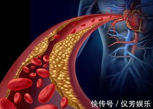 血脂|碳水化合物是高血脂的“催化剂”吗医生除了糖,这3物要忌口