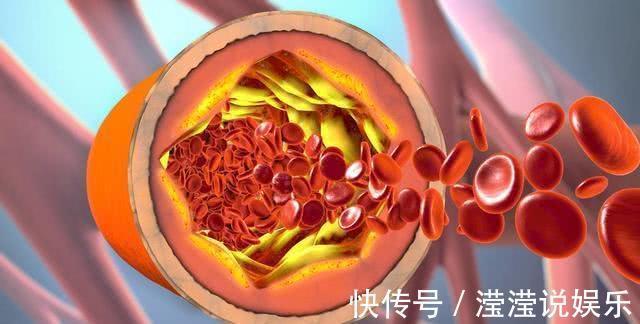 医生|男子突发脑梗，入院就下了病危，医生直言这''习惯''害了不少人