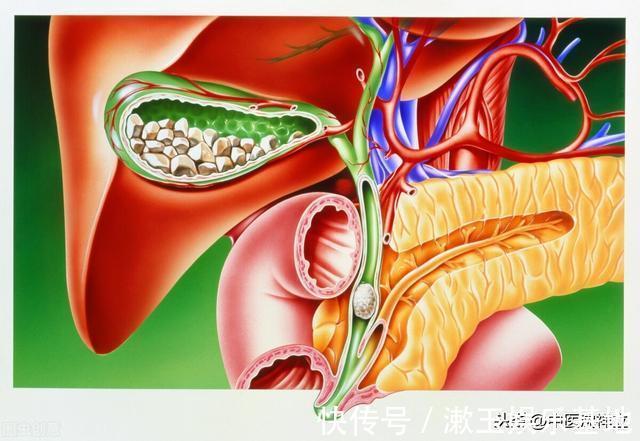 炙甘草|从患者那得来一张治胆囊结石秘方，初看不以为意，细思只有佩服