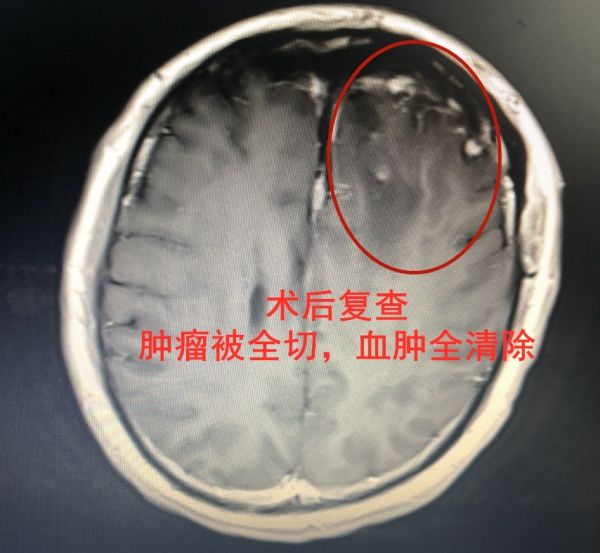 神经外科|莫名头痛头晕，小心脑瘤卒中发作