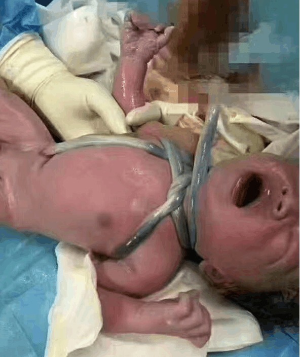 八个月|8个月孕妇摔跤,切开肚子看到婴儿,医生和护士瞬间不淡定
