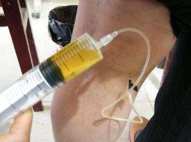 滑膜炎|骨科主任生姜这样用，膝盖不疼了，积液消失了，滑膜炎也好了