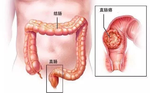 重庆北部宽仁医院|便血8年，确诊2.5cm超低位直肠癌：重庆北部宽仁医院成功挑战极限保肛