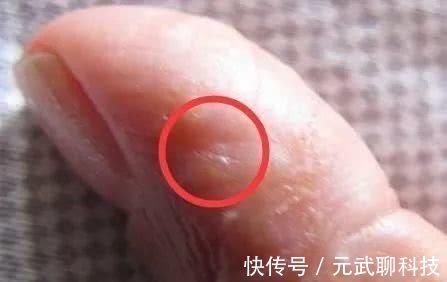 致癌物|手上长透明小水泡，还反复发作？其实不是上火，少做3件事摆脱它