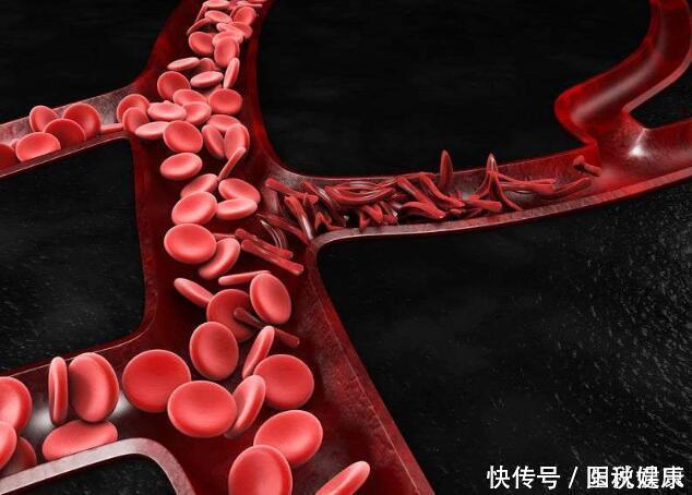 中年后,不想血栓找上身,做好这3件事,能够预防血栓