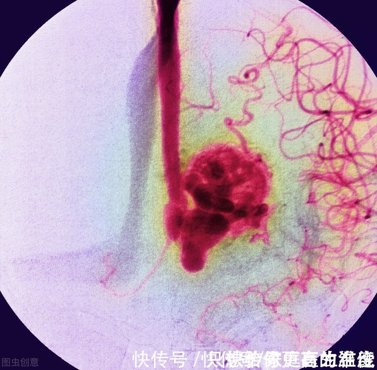 今日头条|血管瘤是怎么回事?需要治疗吗?医生:要根据情况而定