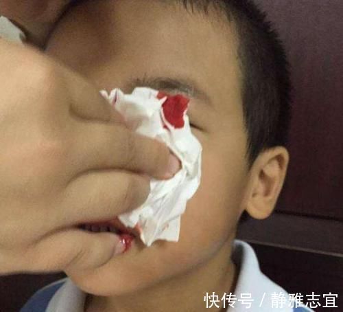 鼻血|3岁男孩摔倒流鼻血，宝妈错误的处理后，医生也“无力回天”