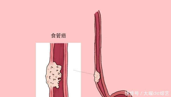 被世卫组织列为第一类致癌物,与烟草同级别,你知道哪些?