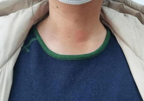 甲状腺肿大|患有甲状腺结节的人，起床时注意这3件事，或对消散结节有帮助