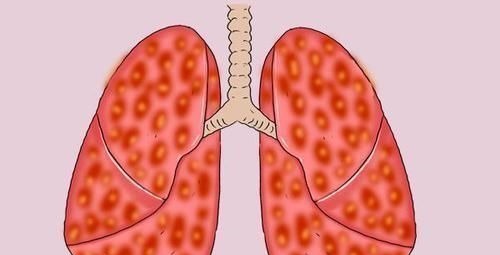 患者|得了肺癌,究竟还能活多久熬过五年生存期,是不是就安全了