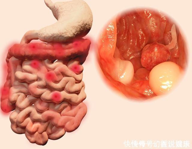 息肉和癌症有什么关系告诫3个部位长息肉，最好及时切除