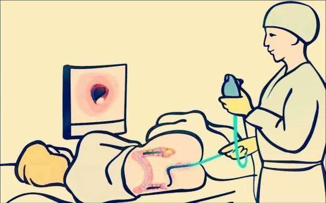 患者|便血患者要注意——千万别把痔疮和肠癌混为一谈