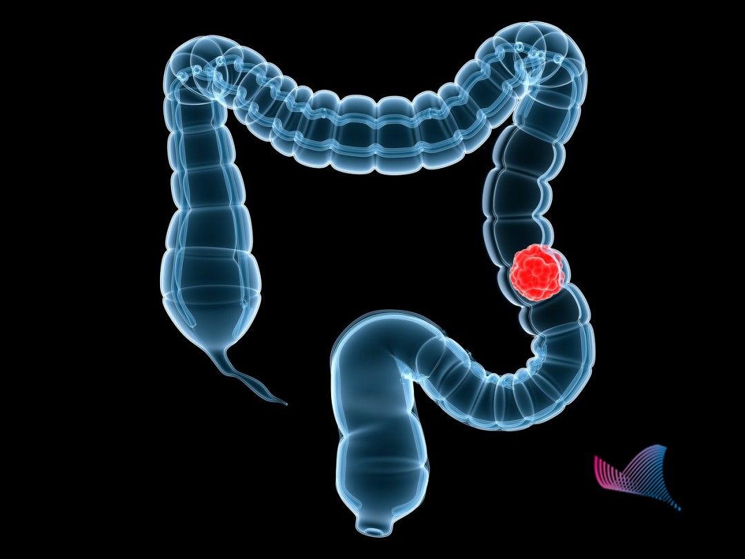 恶性肿瘤|24岁小伙便秘一个月，一查竟是肠癌晚期！身体出现这些变化，要小心了…