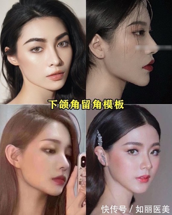 角截骨 下颌角手术的去外板是什么呢？如何判断自己是下颌角肥大还是外板厚呢？