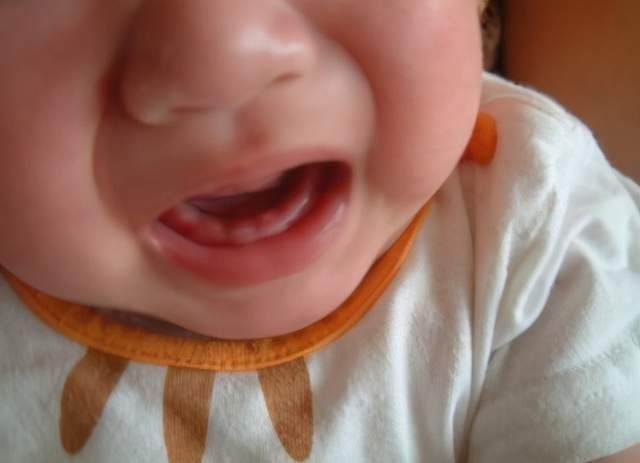 医生|宝宝一出生就有两颗牙齿,宝妈满心欢喜,医生却泼冷水:拔掉吧