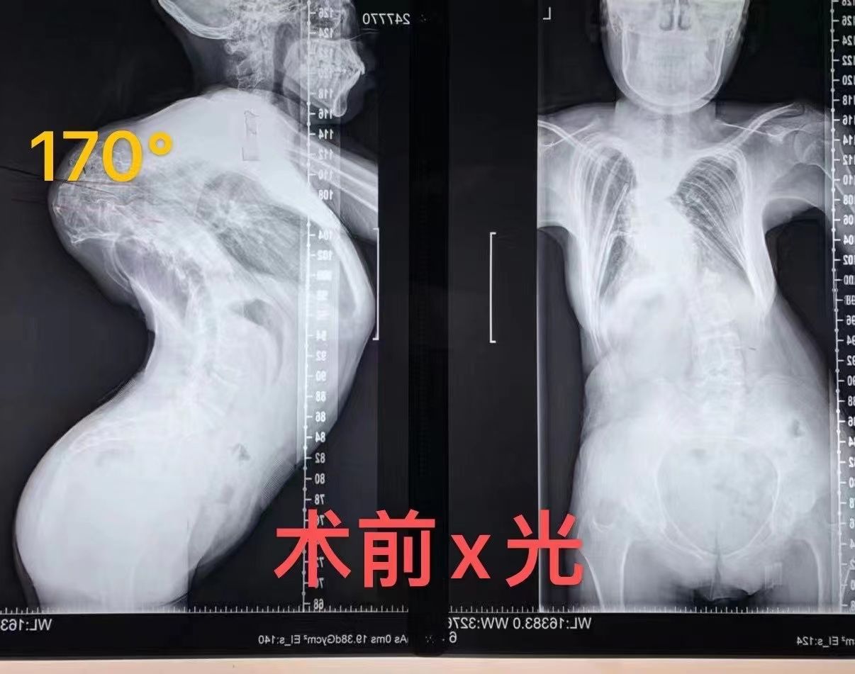 故事|九死一生的手术，这名女大学生比术前长高了12厘米，背后故事感人