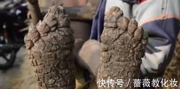 输入图片描述|8岁黑人小孩得怪病，手和脚开始“石化”，医生的话让家人崩溃！