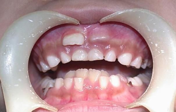 糖果|越来越多孩子长“双排牙”,与糖果无关,是父母喂养有误区