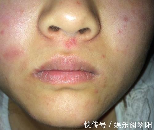 肝火旺盛|三伏天里吃一口等于5斤绿豆,呼吁:肝火旺不妨常吃,或能降火排毒