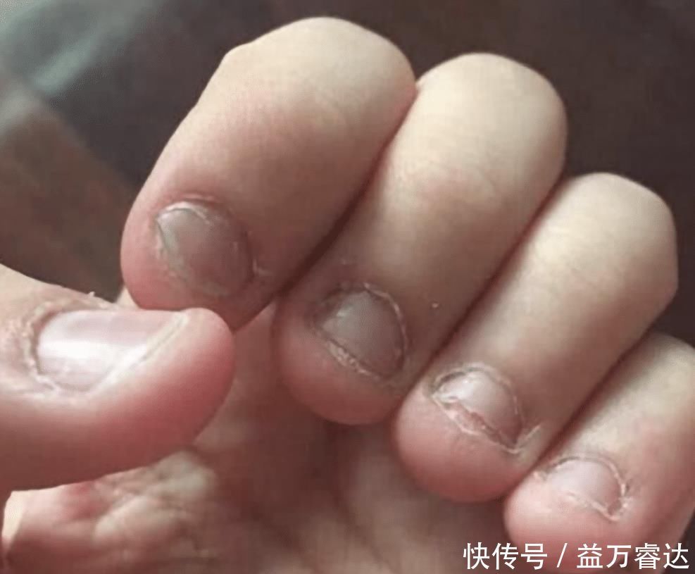心理|从小“咬指甲”的孩子,长大后会怎样?专家坦言:逃不开2种结局