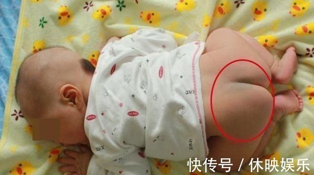皮肤病|发现新生儿小屁屁上有“淤青”,老公想找护士理论,最后暗暗庆幸