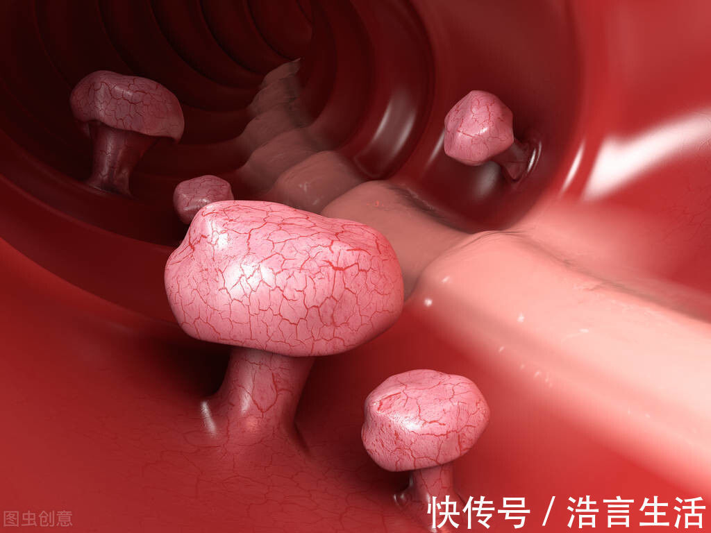 胃息肉|息肉都会发生癌变并不是,揭秘这4种常见息肉的癌变几率