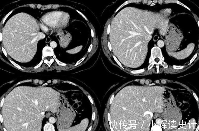 生存率|癌症多久不复发算治愈?若4项指标全正常,或离治愈不远了