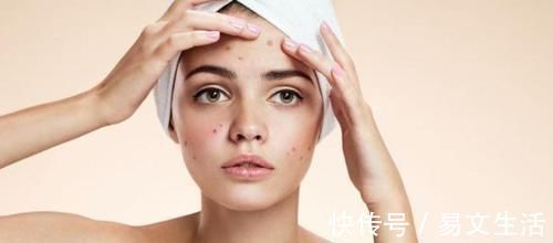 痘痘|痘痘,用什么药效果好?可以尝试用5种药!