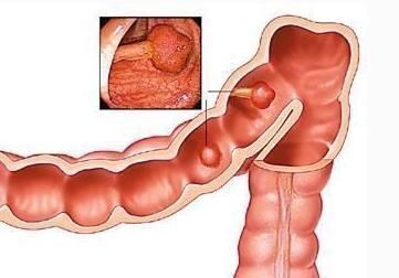 癌变率|实用!息肉一定会癌变吗?肿瘤医院的专家们告诉你答案