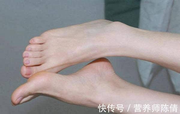 扁平足|女人有没有衰老,看脚部这4种衰老信号,但愿你没有