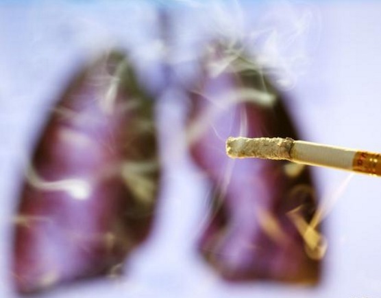 肺部|肺不好的人，头部若有3个表现，可能肺癌要来，最好去检查一下