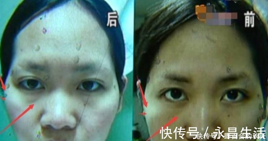 太阳穴|瘦脸后被同事说老了,女子找整形医院退钱,医生:每个人底子不同
