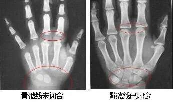 晚长|天使课堂:如何鉴别是晚长还是真矮,主要看这些特征