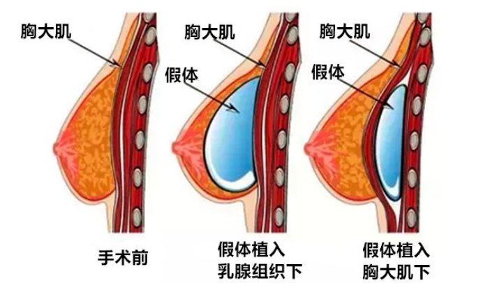 乳房|假体隆胸手术的小秘密，你都知道多少？