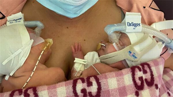 怀孕22周零5天 女子早产生下1斤重双胞胎