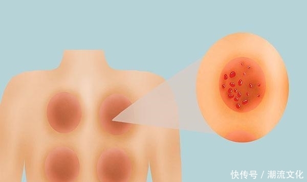 拔罐能排毒吗？拔罐时，红印越深说明什么？