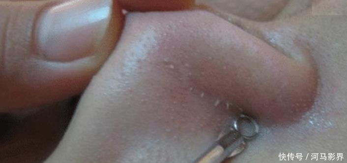 小疙瘩|抿紧下巴后突起的“白疙瘩”,千万要注意,这是螨虫的真身吗