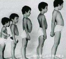 脑血管病|共济失调症临床表现