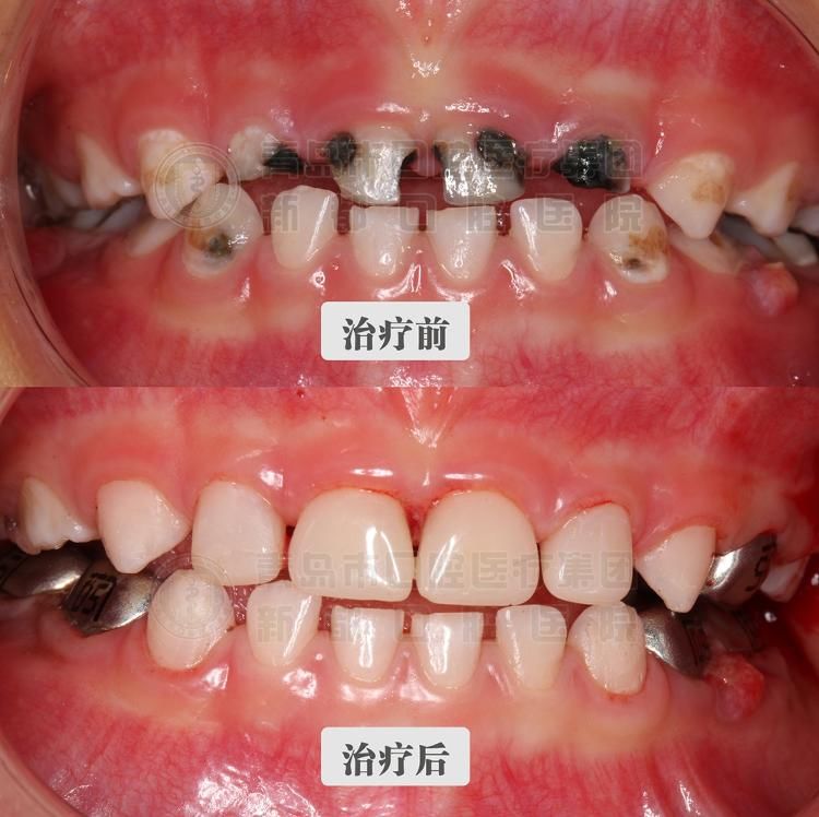 舒适|3岁男童“一觉”醒来满口烂牙变白牙 无痛舒适化口腔治疗让孩子轻松看好牙