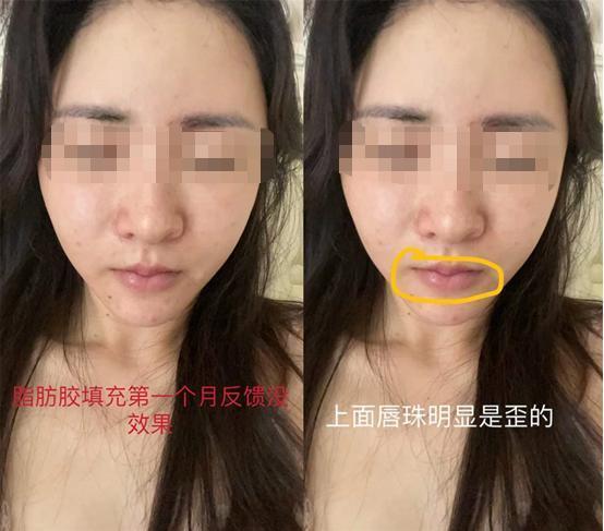 咨询师 医美整形失败，求退费 为何这么难？