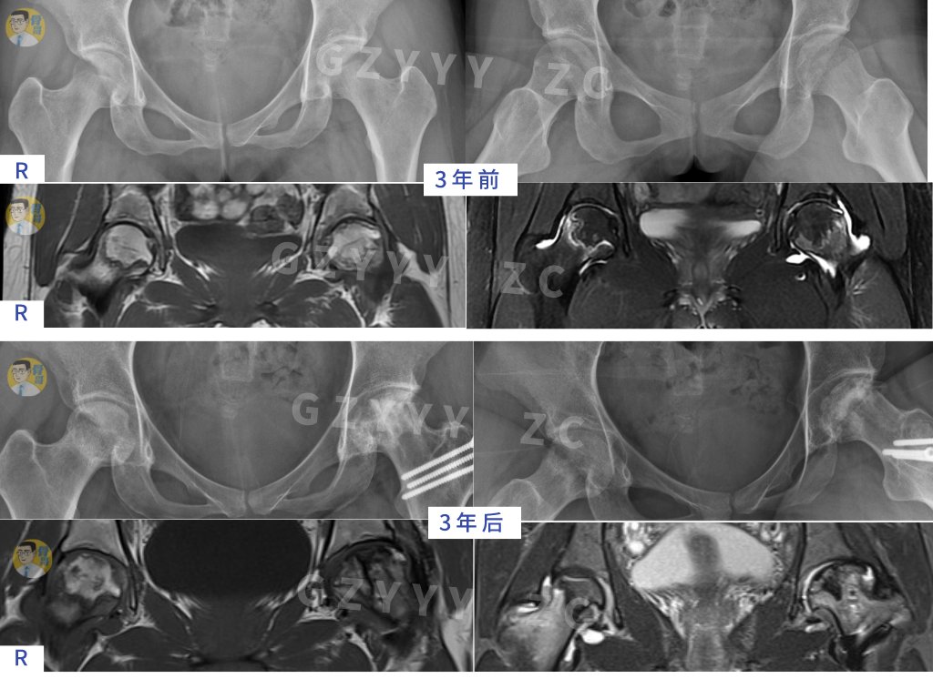 手术|看准、选对、做好——股骨头坏死保髋就这样成功了？