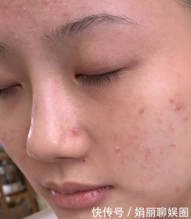 洗脸|用香皂洗脸会长痘痘吗?哪个牌子的洗脸皂比较好?