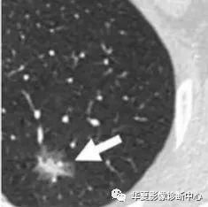 患者|从肺结节到肺癌，10个月影像记录，提醒我们正确对待肺结节处理