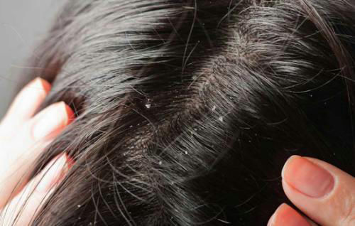 侧柏叶|想要发不白、发不脱?中医的这些方法,你早该用上!