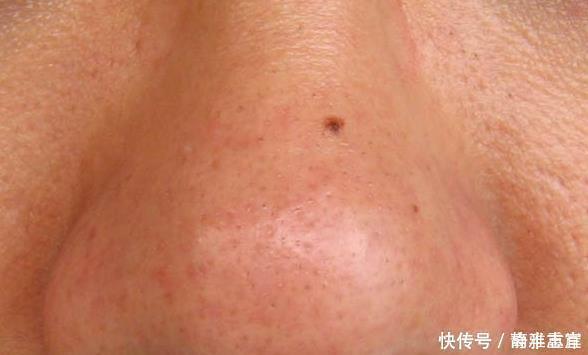 皮肤科|皮肤科医生:这4物去黑头,坚持个把月,黑头就好很多